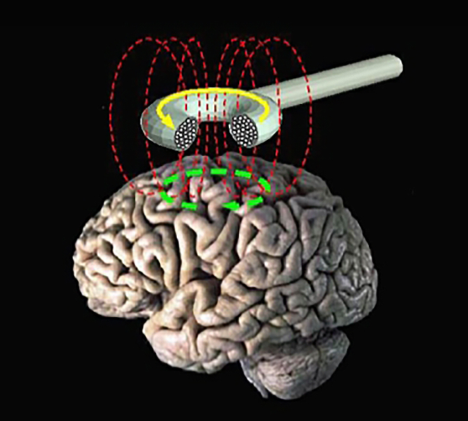 Repetitive transcranial magnetic stimulation (rTMS).jpg
